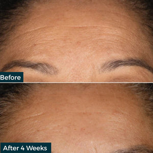 Before and after comparison of forehead skin texture with 'Before' on top and 'After 4 Weeks' on bottom.